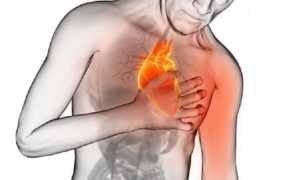 infarto miocardico