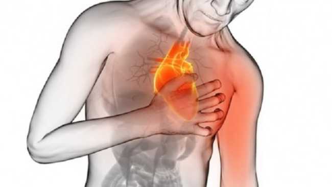 infarto miocardico